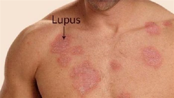 bệnh lupus