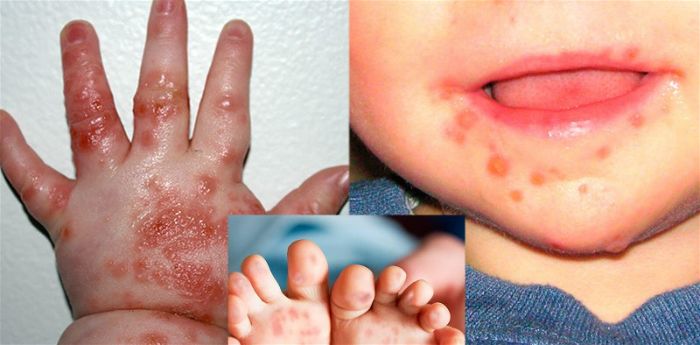 Dấu hiệu triệu chứng sớm khi trẻ bị tay chân miệng